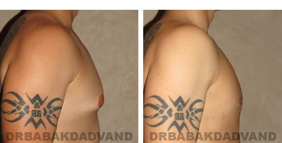 Gynecomastia. Before and After Treatment Photos - male, right side oblique view (patient 21)
