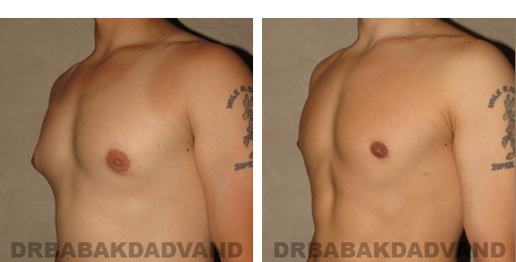 Gynecomastia. Before and After Treatment Photos - male, left side view (patient 21)