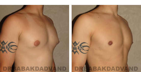 Gynecomastia. Before and After Treatment Photos - male, right side view (patient 21)