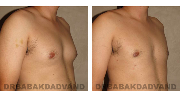 Gynecomastia. Before and After Treatment Photos - male, right side view (patient 22)