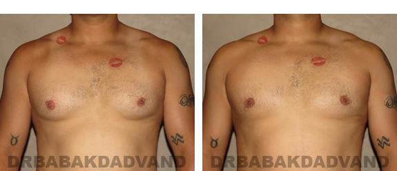 Gynecomastia. Before and After Treatment Photos - male, front view (patient 23)