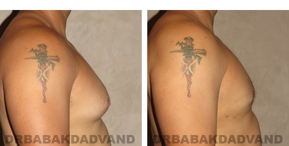 Gynecomastia. Before and After Treatment Photos - male, right side view (patient 23)