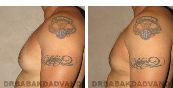Gynecomastia. Before and After Treatment Photos - male, left side view (patient 23)
