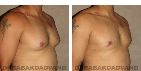 Gynecomastia. Before and After Treatment Photos - male, right side oblique view (patient 23)