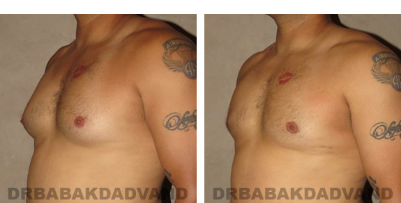 Gynecomastia. Before and After Treatment Photos - male, left side oblique view (patient 23)