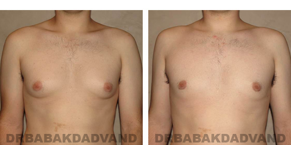 Gynecomastia. Before and After Treatment Photos - male, front view (patient 24)