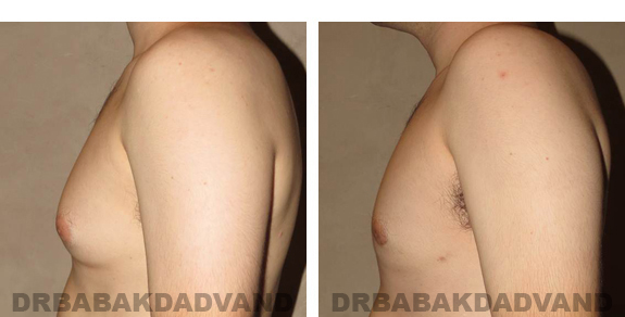 Gynecomastia. Before and After Treatment Photos - male, left side view (patient 24)