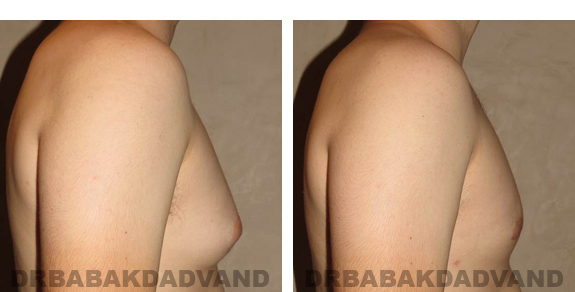 Gynecomastia. Before and After Treatment Photos - male, right side view (patient 24)