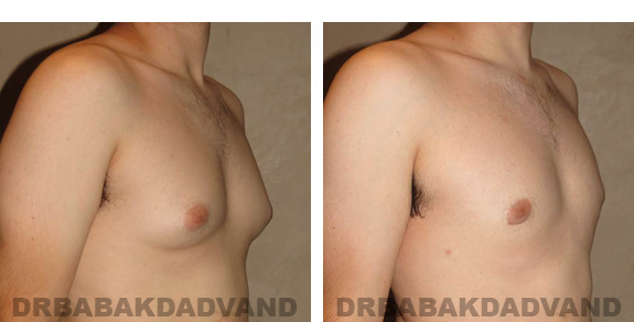 Gynecomastia. Before and After Treatment Photos - male, right side oblique view (patient 24)