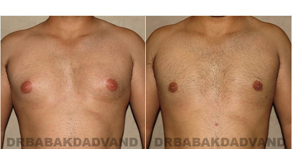Gynecomastia. Before and After Treatment Photos - male, front view (patient 27)