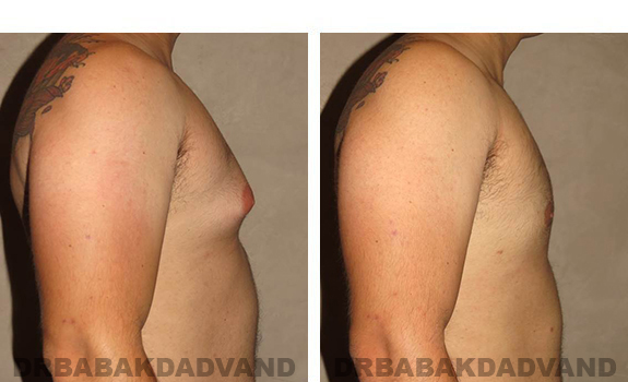 Gynecomastia. Before and After Treatment Photos - male, right side view (patient 27)