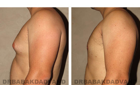 Gynecomastia. Before and After Treatment Photos - male, left side view (patient 27)
