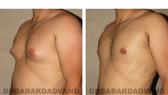 Gynecomastia. Before and After Treatment Photos - male, left side oblique view (patient 27)