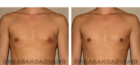 Gynecomastia. Before and After Treatment Photos - male, front view (patient 28)