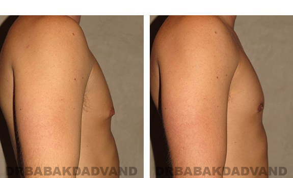 Gynecomastia. Before and After Treatment Photos - male, right side view (patient 28)