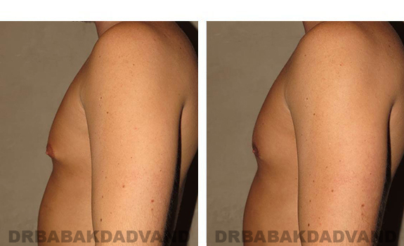 Gynecomastia. Before and After Treatment Photos - male, left side view (patient 28)