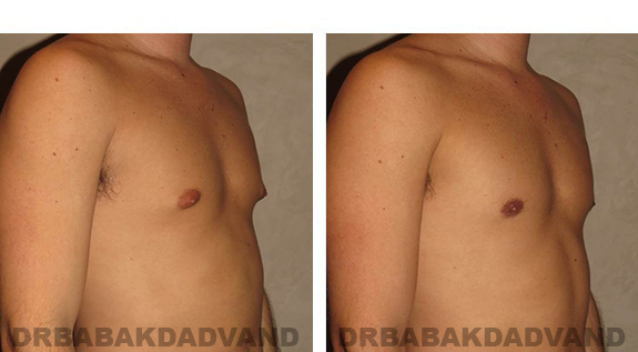 Gynecomastia. Before and After Treatment Photos - male, right side oblique view (patient 28)