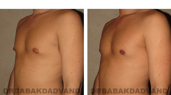 Gynecomastia. Before and After Treatment Photos - male, left side oblique view (patient 28)