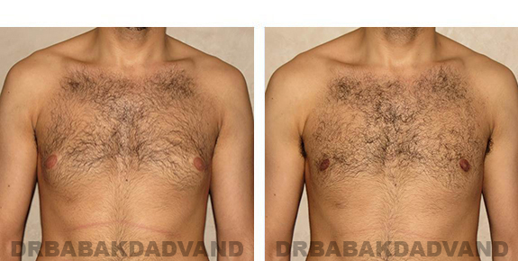 Gynecomastia. Before and After Treatment Photos - male, front view (patient 30)