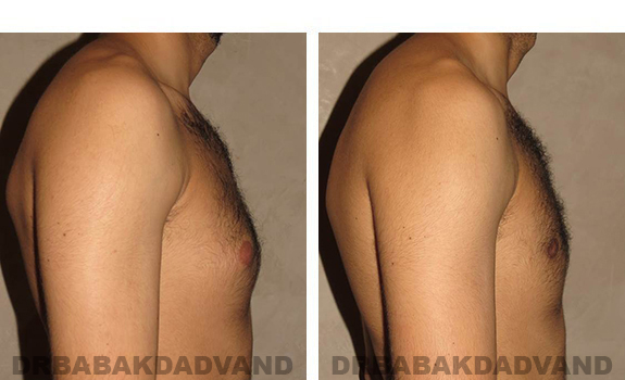 Gynecomastia. Before and After Treatment Photos - male, right side view (patient 30)