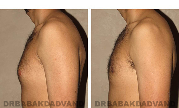 Gynecomastia. Before and After Treatment Photos - male, left side view (patient 30)