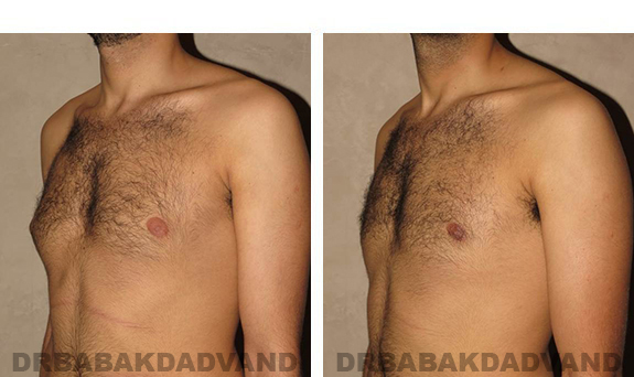 Gynecomastia. Before and After Treatment Photos - male, left side oblique view (patient 30)