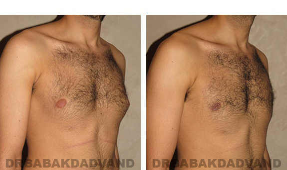 Gynecomastia. Before and After Treatment Photos - male, right side oblique view (patient 30)