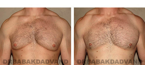 Gynecomastia. Before and After Treatment Photos - male, front view (patient 31)