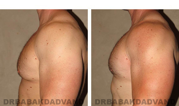 Gynecomastia. Before and After Treatment Photos - male, left side view (patient 31)