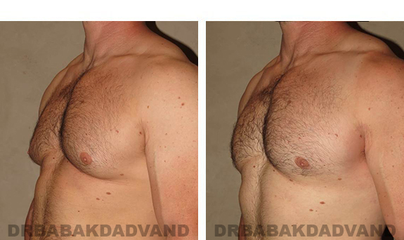 Gynecomastia. Before and After Treatment Photos - male, left side oblique view (patient 31)