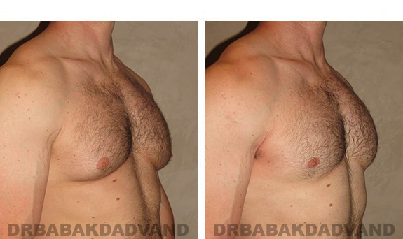 Gynecomastia. Before and After Treatment Photos - male, right side oblique view (patient 31)
