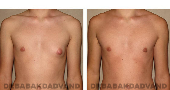 Gynecomastia. Before and After Treatment Photos - male, front view (patient 32)