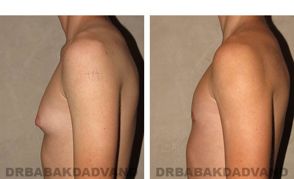 Gynecomastia. Before and After Treatment Photos - male, left side view (patient 32)
