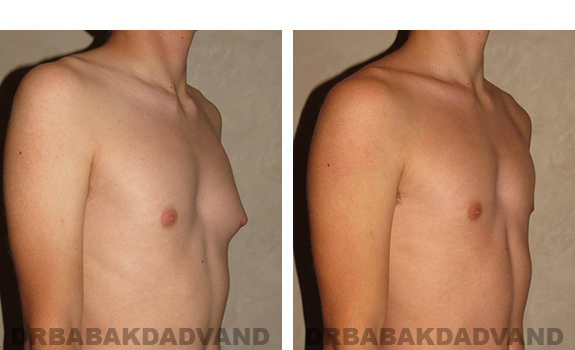 Gynecomastia. Before and After Treatment Photos - male, right side oblique view (patient 32)