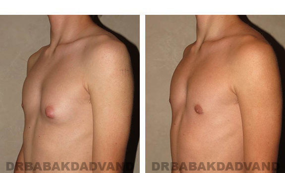 Gynecomastia. Before and After Treatment Photos - male, left side oblique view (patient 32)