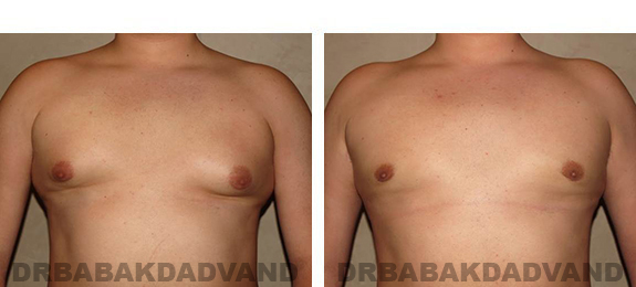 Gynecomastia. Before and After Treatment Photos - male, front view (patient 33)
