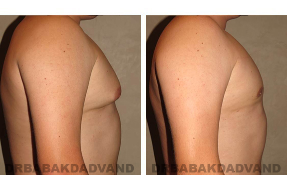 Gynecomastia. Before and After Treatment Photos - male, right side view (patient 33)