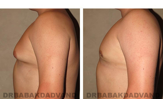 Gynecomastia. Before and After Treatment Photos - male, left side view (patient 33)