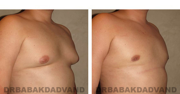 Gynecomastia. Before and After Treatment Photos - male, right side oblique view (patient 33)
