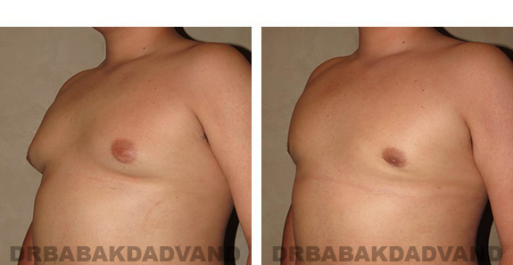 Gynecomastia. Before and After Treatment Photos - male, left side oblique view (patient 33)