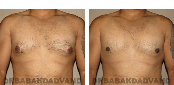 Gynecomastia. Before and After Treatment Photos - male, front view (patient 34)