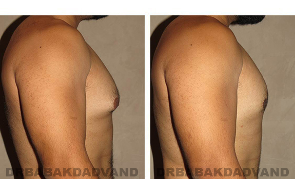 Gynecomastia. Before and After Treatment Photos - male, right side view (patient 34)