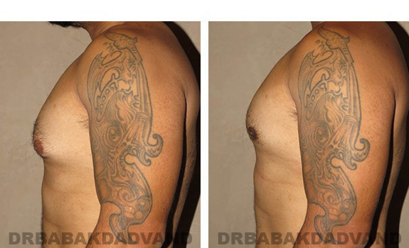 Gynecomastia. Before and After Treatment Photos - male, left side view (patient 34)