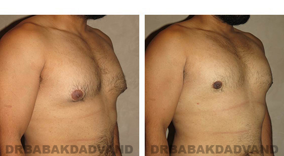Gynecomastia. Before and After Treatment Photos - male, right side oblique view (patient 34)