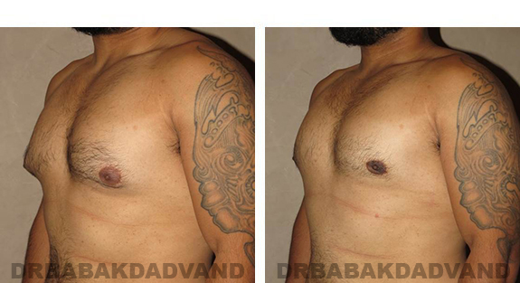 Gynecomastia. Before and After Treatment Photos - male, left side oblique view (patient 34)