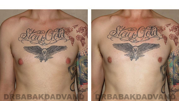 Gynecomastia. Before and After Treatment Photos - male, front view (patient 35)