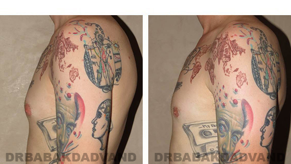 Gynecomastia. Before and After Treatment Photos - male, left side view (patient 35)
