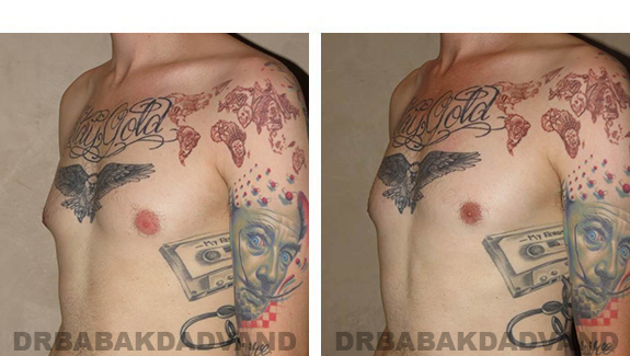 Gynecomastia. Before and After Treatment Photos - male, left side oblique view (patient 35)