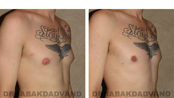 Gynecomastia. Before and After Treatment Photos - male, right side oblique view (patient 35)