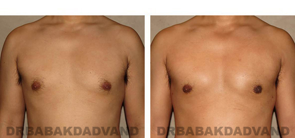 Gynecomastia. Before and After Treatment Photos - male, front view (patient 36)